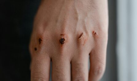 Photo by MART PRODUCTION: https://www.pexels.com/photo/wounded-knuckles-7699460/