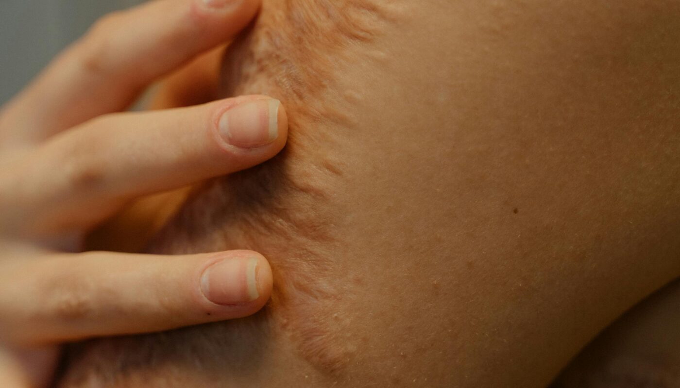 Photo by Ron Lach : https://www.pexels.com/photo/a-close-up-shot-of-a-person-s-skin-with-scars-8626329/