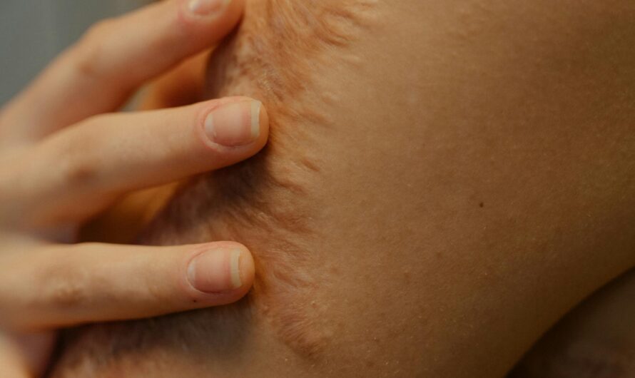 How Scar Tissue Can Influence Ongoing Pain Sensations